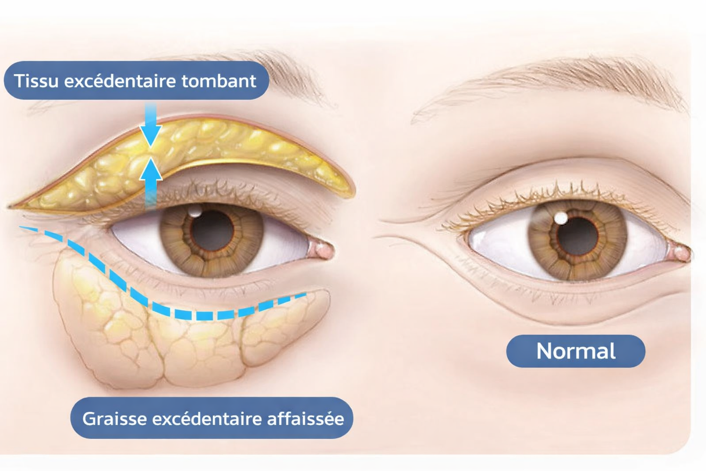 OPENEYES Gel contour des yeux liftant aux peptides Awaken